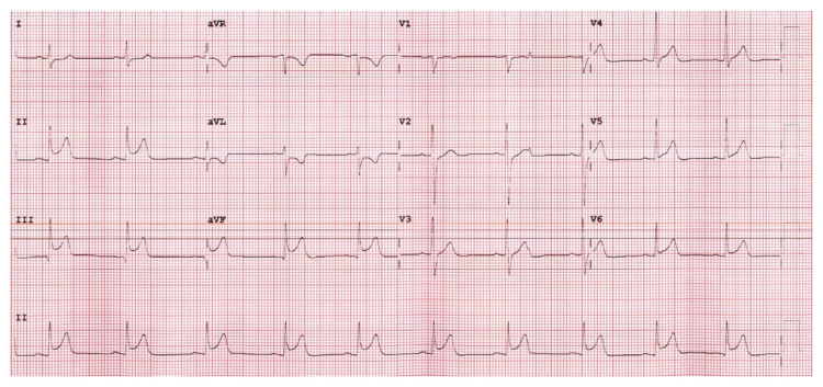 Successful Primary Coronary Intervention During Prolonged Mechanical Cardiopulmonary Resuscitation for Acute Myocardial Infarction-related Cardiac Arrest.