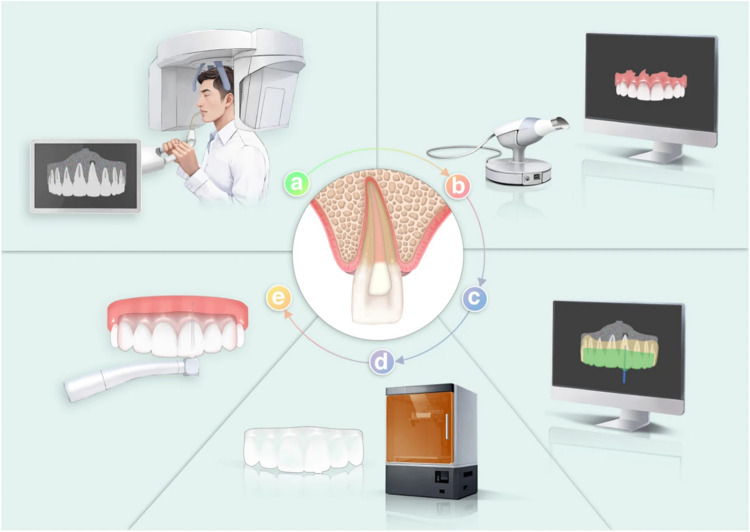 Guided endodontics in the application of personalized mini-invasive treatment in clinical cases: a literature review.