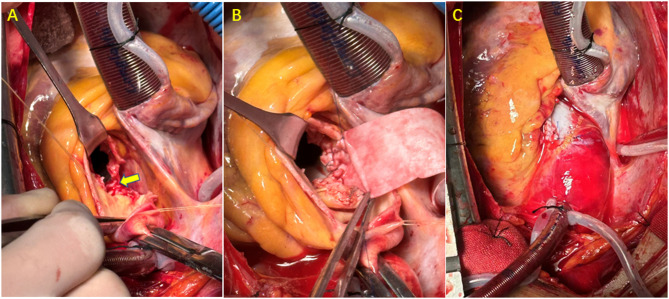 Aortic annulus reconstruction with bovine pericardium during aortic valve replacement for severe calcific aortic stenosis.