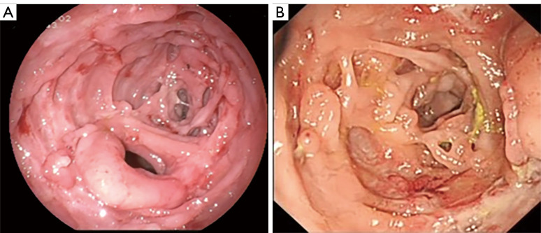 Loss-of-function of lipopolysaccharide-responsive beige-like anchor protein causes inflammatory bowel disease-a case report and literature review.