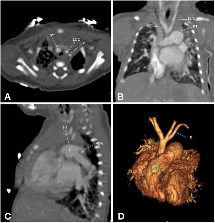 A comparative analysis of CT angiography and echocardiography in the evaluation of chest findings in patients with interrupted aortic arch.
