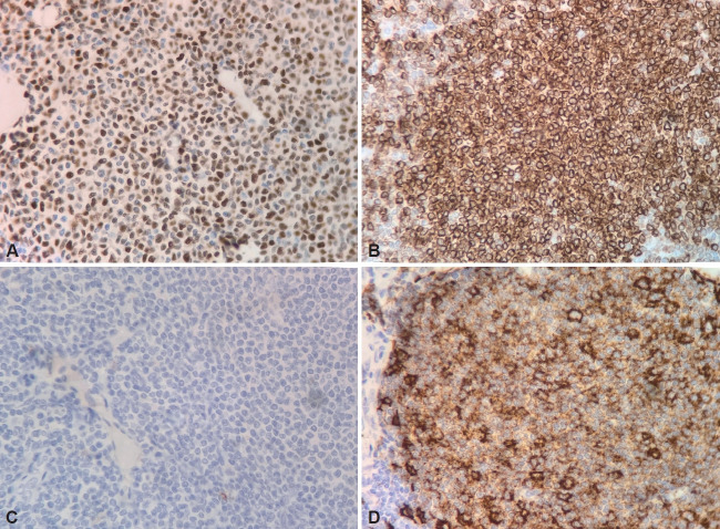 Gastric Adenocarcinoma and Synchronic Mantle Cell Lymphoma: A Case Report.