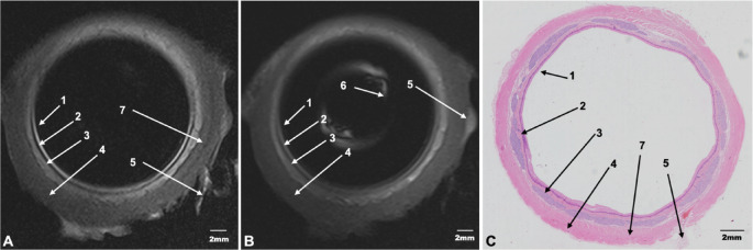 Ex vivo study of Porcine esophagus magnetic resonance imaging with a compact endoluminal coil.
