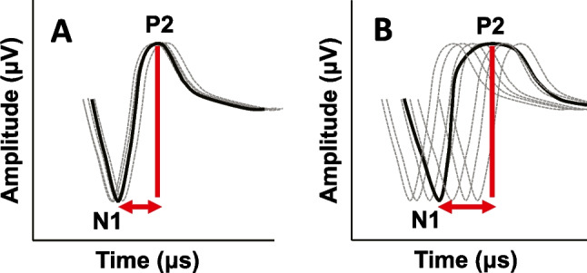 Contributions of Auditory Nerve Density and Synchrony to Speech Understanding in Older Cochlear Implant Users.