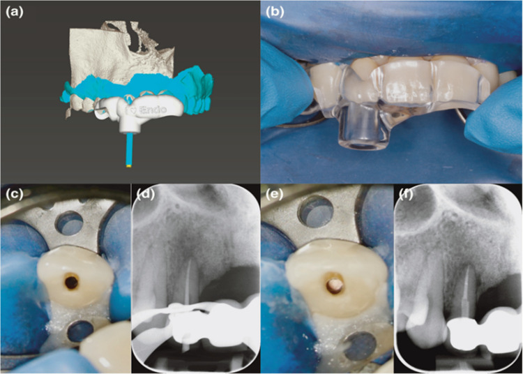 Guided endodontics in the application of personalized mini-invasive treatment in clinical cases: a literature review.