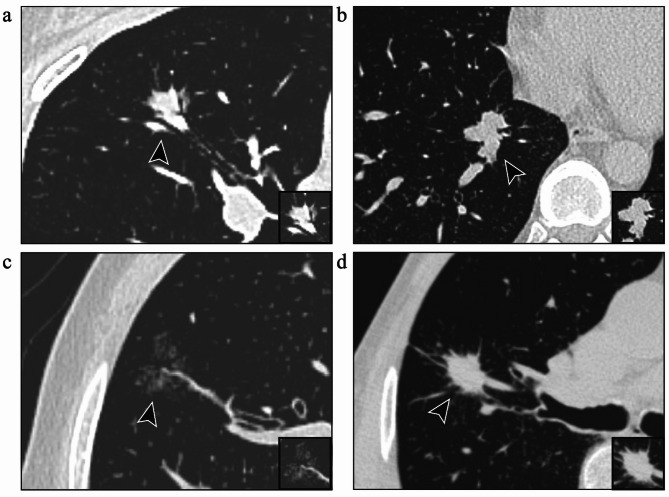 CT feature-based nomogram for predicting tumor spread through air spaces in stage IA lung adenocarcinoma.