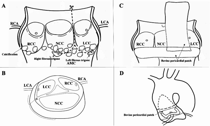 Aortic annulus reconstruction with bovine pericardium during aortic valve replacement for severe calcific aortic stenosis.