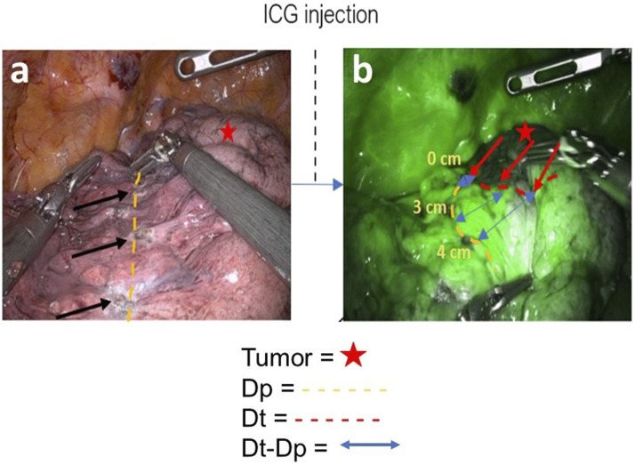 Near-Infrared Fluorescence-Guided Segmentectomy: Added Benefit of Indocyanine Green Dye Diminishes With Surgeon Experience.