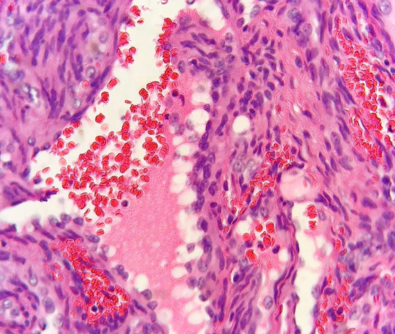Immunohistochemical Analysis of Oral Spindle Cell Hemangioma.