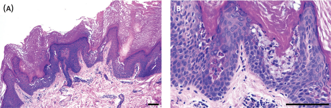 Congenital Segmental Erosions and Hyperkeratotic Plaques in a Male Infant: A Quiz.