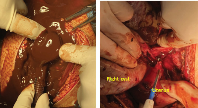 Silent Threat: Bilateral Giant Asymptomatic Endometriotic Cysts With Unilateral Sudden Rupture-A Case Report.