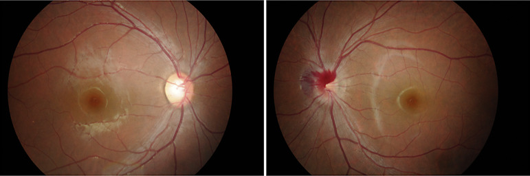 Intrapapillary Hemorrhage with Adjacent Peripapillary Subretinal Hemorrhage in a 9-Year-Old Girl: A Case Report.