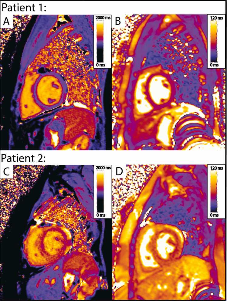 Multiparametric cardiovascular magnetic resonance is associated with outcomes in pediatric heart transplant recipients.