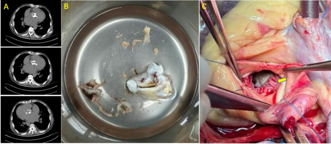 Aortic annulus reconstruction with bovine pericardium during aortic valve replacement for severe calcific aortic stenosis.