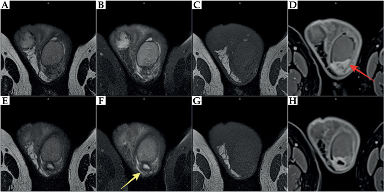 Orchiepididymitis as a rare complication of TURP performed four weeks after high-dose-rate brachytherapy for prostate cancer.