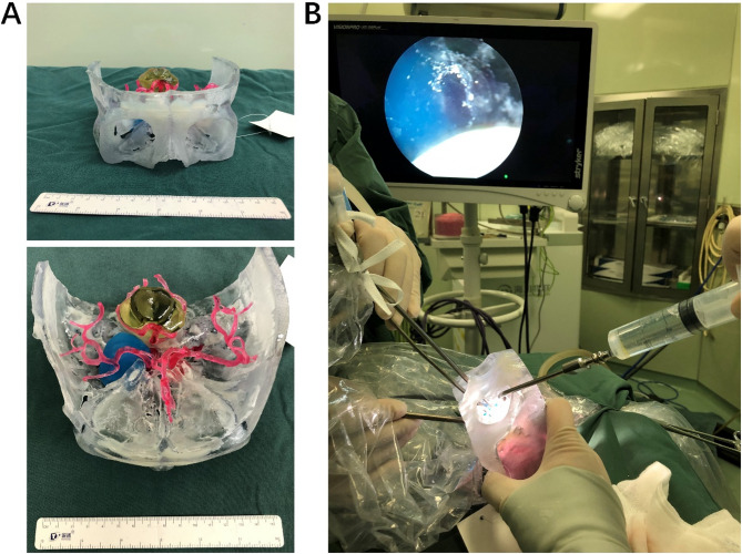 Enhancing skull base tumor management: the combination of 3D printing technology and endoscopic surgical techniques.