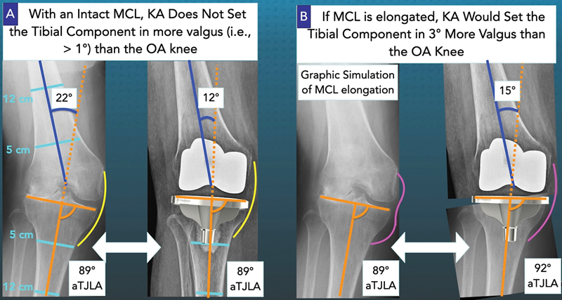 No Radiographic Evidence of Medial Collateral Ligament Elongation in Valgus Osteoarthritic Knees Enables Treatment with Kinematically Aligned Total Knee Arthroplasty.