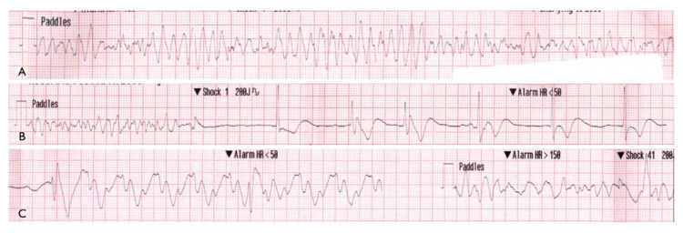 Successful Primary Coronary Intervention During Prolonged Mechanical Cardiopulmonary Resuscitation for Acute Myocardial Infarction-related Cardiac Arrest.