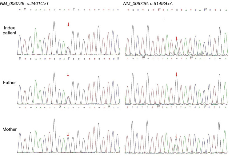 Loss-of-function of lipopolysaccharide-responsive beige-like anchor protein causes inflammatory bowel disease-a case report and literature review.