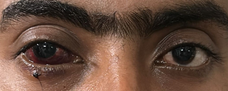 Magnetic Extraction of an Intraretinal Foreign Body: A Case Report.