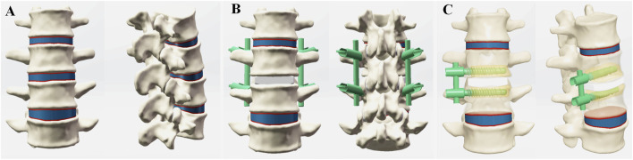 Clinical evaluation and finite element analysis of bone cement-augmented anterolateral screw fixation versus percutaneous bilateral pedicle screw fixation co-applied with oblique lumbar interbody fusion for single-level lumbar degenerative diseases with osteoporosis.