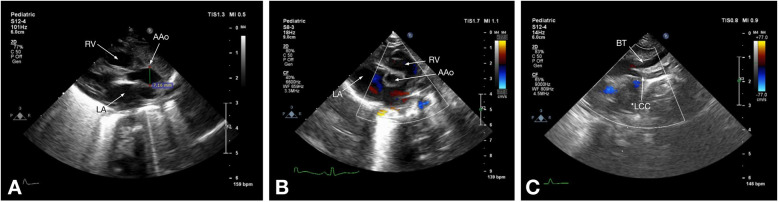 A comparative analysis of CT angiography and echocardiography in the evaluation of chest findings in patients with interrupted aortic arch.