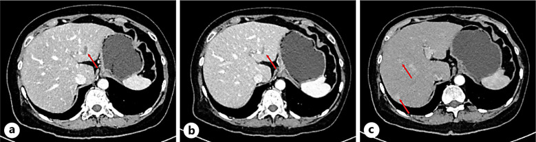 Prolonged Progression-Free Survival in a Patient with Highly Pretreated Recurrent Ovarian Cancer after Developing Multisystem Immune-Related Adverse Events: A Case Report and Literature Review.