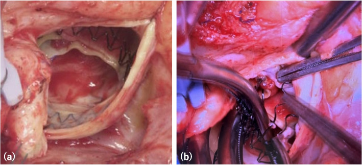 Infective endocarditis with perivalvular abscess following sutureless valve implantation, successfully treated with aortic root reconstruction and biological Bentall procedure.