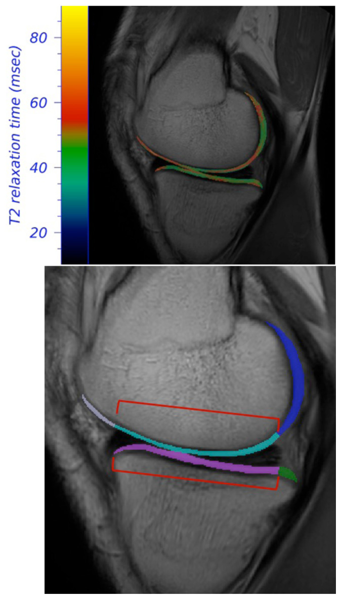 Sedentary Behavior Patterns After ACL Reconstruction.