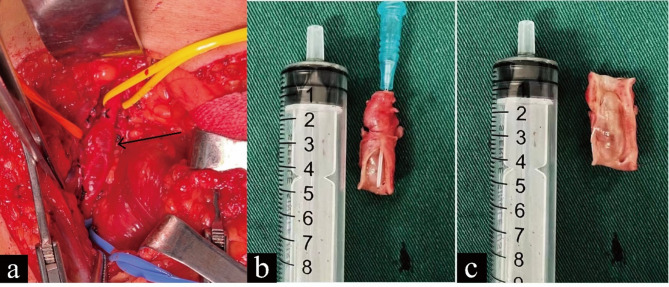 Cystic adventitial disease of the popliteal artery in female: case report and literature review of a rare differential diagnose of artery stenosis.