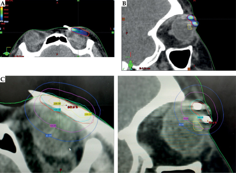 The irreplaceable art of brachytherapy: A technical note on interstitial high-dose-rate interventional radiotherapy (brachytherapy) in eyelid tumors.