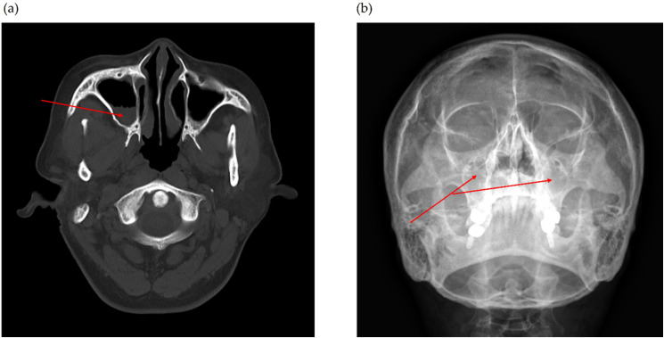Management of Perennial Allergic Rhinitis Complicated by Rhinosinusitis Using Ultrasound-Guided Sphenopalatine Ganglion Acupuncture and Modified Socheongryong-tang: two CARE-compliant case reports.