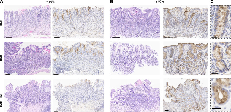 Patterns of sialyl-Lewis X expression predict gastric histopathology.