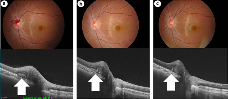 Intrapapillary Hemorrhage with Adjacent Peripapillary Subretinal Hemorrhage in a 9-Year-Old Girl: A Case Report.