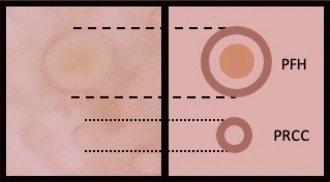 Pigmented Rings With Central Clearing: A Dermoscopic Feature of Melasma.