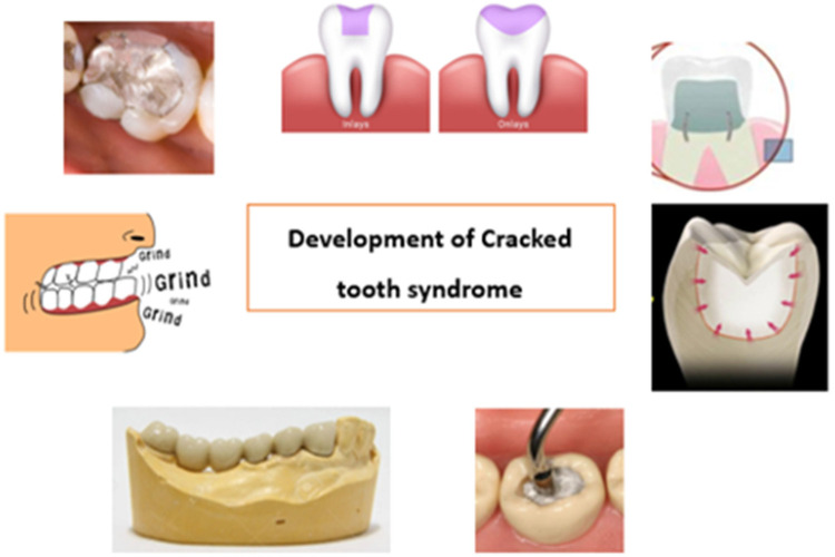 Cracked tooth syndrome: a diagnostic dilemma- a mini review.