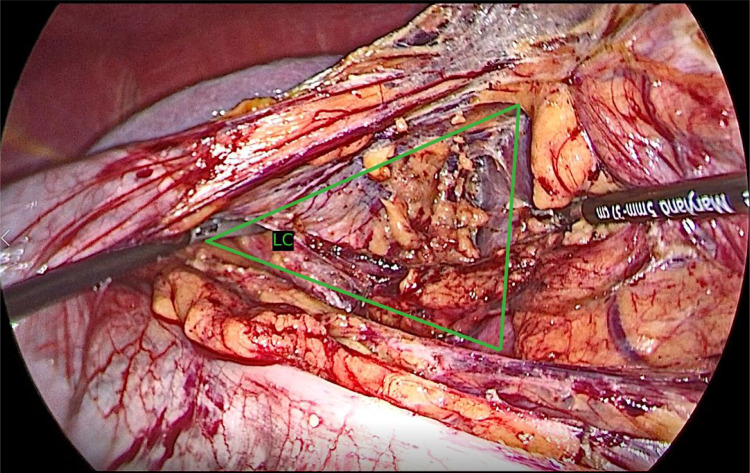 Optimized Surgical Outcomes in Living Donor Nephrectomy: A Single-Center Experience with 250 Cases Using a Novel Technique.