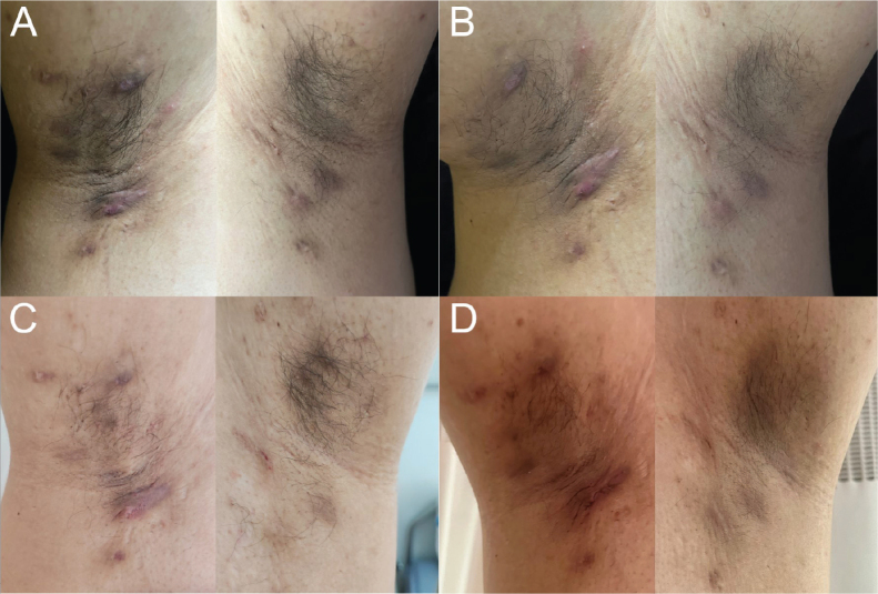 Successful Control of Refractory Hidradenitis Suppurativa with Spesolimab: A Case Report.