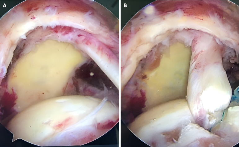 Clinical comparison of arthroscopic double-row rotator cuff repair with or without long head of biceps tendon transposition.