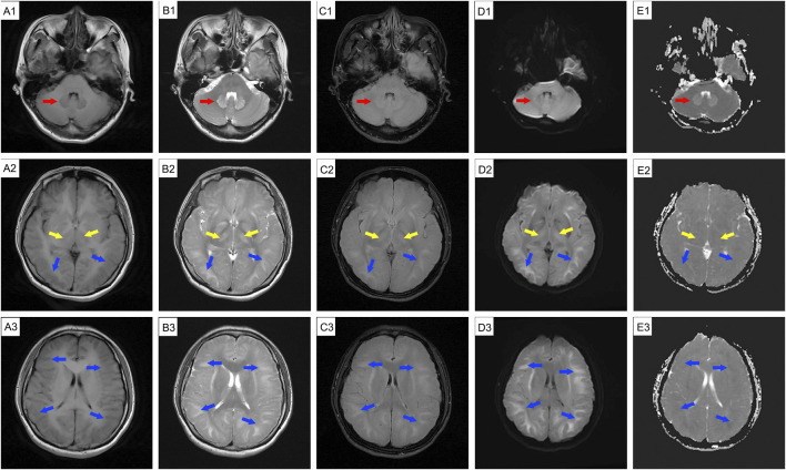 Case Report: Evaluating toxic encephalopathy from occupational 1,2-dichloroethane exposure: magnetic resonance imaging contributions.