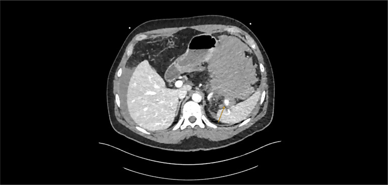 Post-Pancreatitis Splenic Artery Pseudoaneurysm as a Luring Danger: A Case Report.