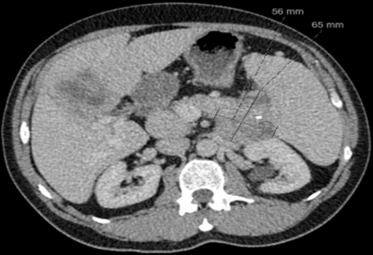 Pancreatic neuroendocrine tumors: A case-based evidence review.