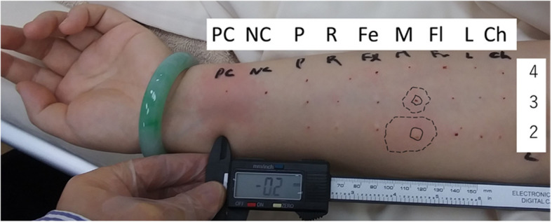 Anaphylaxis due to midazolam administered before induction of general anesthesia: a case report.