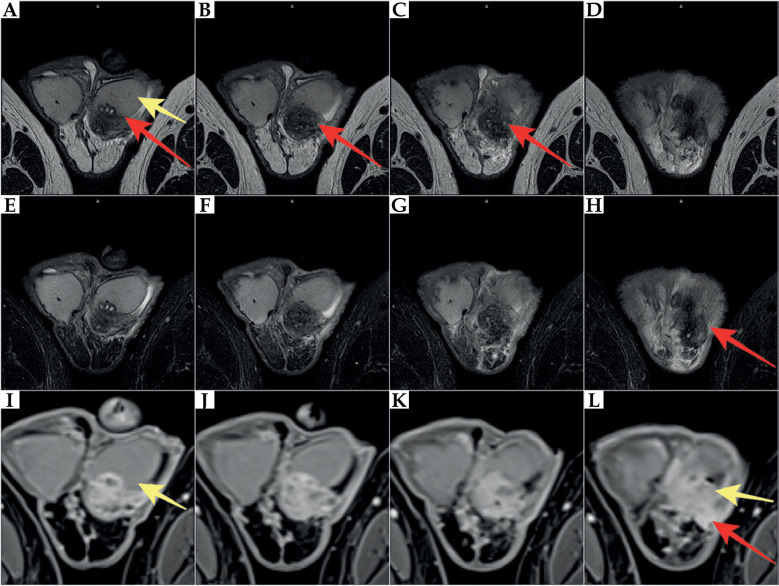 Orchiepididymitis as a rare complication of TURP performed four weeks after high-dose-rate brachytherapy for prostate cancer.