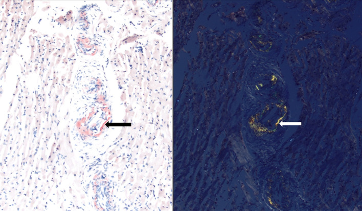 Light Chain (AL) Amyloidosis Masquerading as Scleroderma: A Diagnostic Challenge.