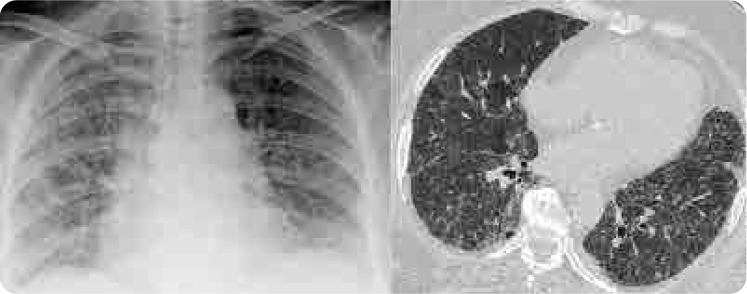 Methotrexate-Associated Hypersensitivity Pneumonitis After 15 Years of Use: A Case Report and Literature Review.