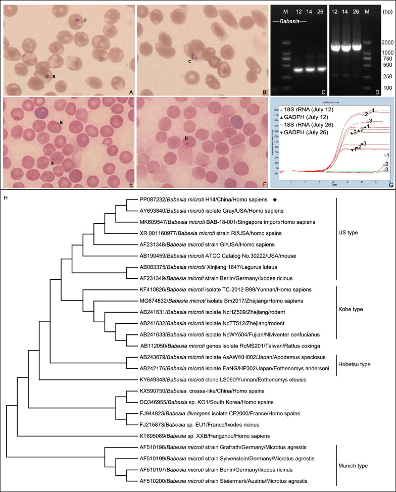 Babesia microti (Babesiidae, Piroplasmida) infection in a Chinese traveler returning from the United States of America.