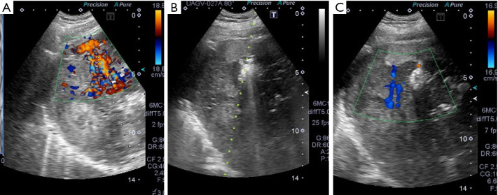 Tract hemostasis using radiofrequency ablation for hepatic arterial bleeding after percutaneous transhepatic portal embolization.
