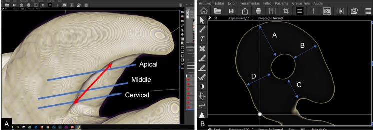 Residual dentin thickness in maxillary first premolars with palatal groove after endodontic and restorative procedures: An e-Vol DX analysis.