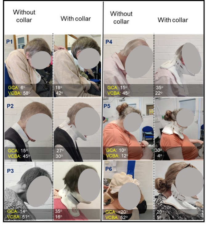 Clinical case study on custom 3D printed collars for dropped head syndrome patients.